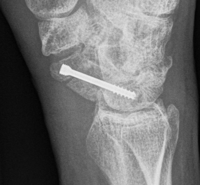 Scaphoid Nonunion Iliac Crest Bone Graft